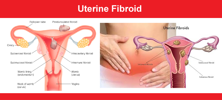 Fibroids are abnormal growths that develop in or on a woman’s uterus. Sometimes, these tumors become quite large and cause severe abdominal pain and heavy periods.