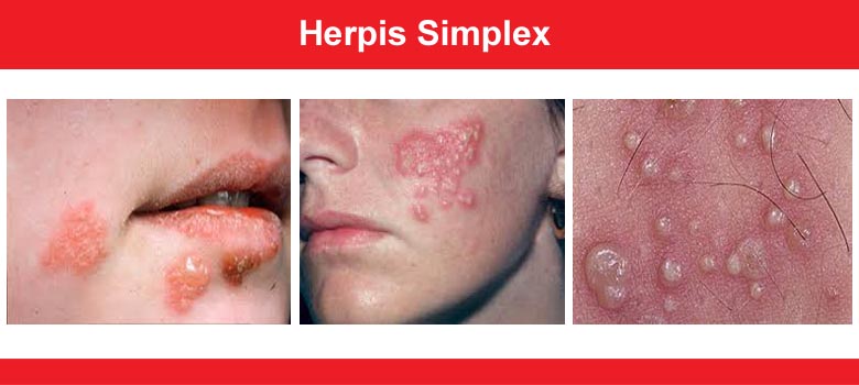 Herpes