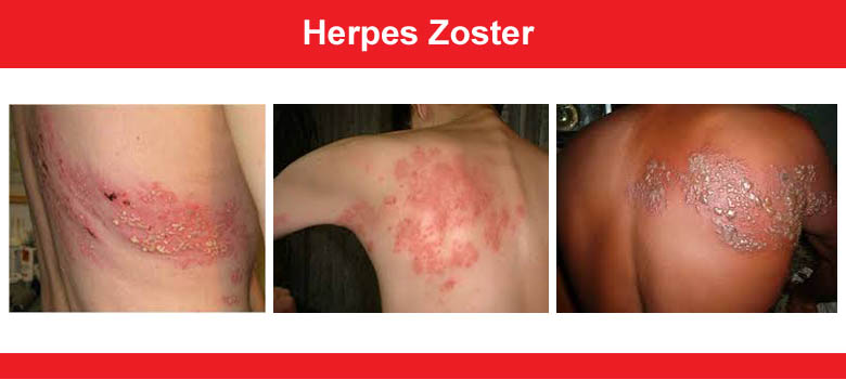 Herpes zoster