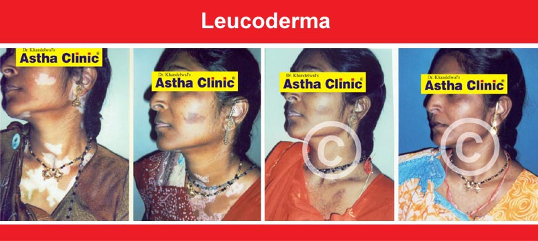 Leucoderma