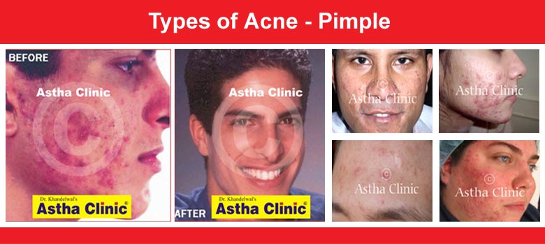 Pimples (Acne)