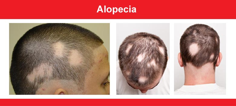 Alopecia