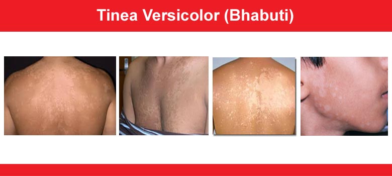 Tinea Versicolor (Bhabuti)