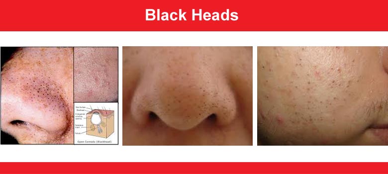 Blackheads - Whiteheads