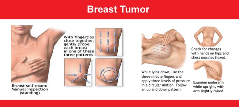 Breast Tumor (Fibroadenoma)