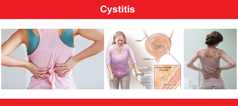 Cystitis