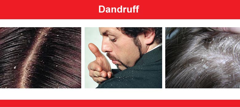Dandruff (seborrhea)