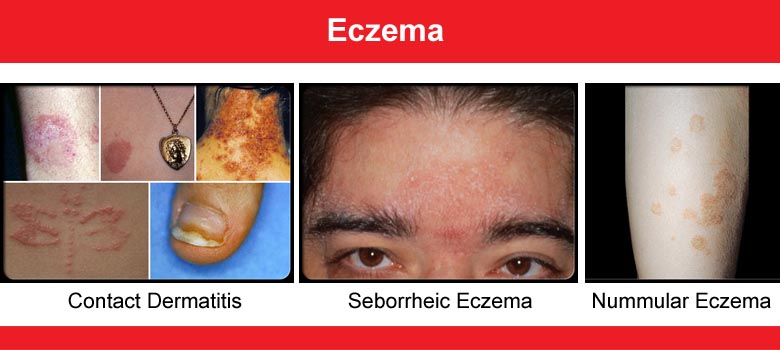 Eczema