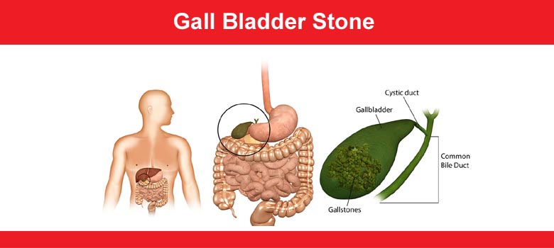 Gall Bladder Stone