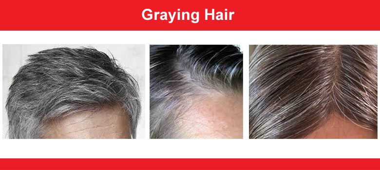 Hair Graying (Premature Graying)