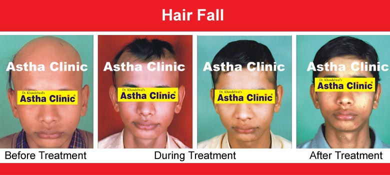 Hair Loss (Hair Falling)