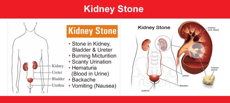 Kidney Stone (Calculus)