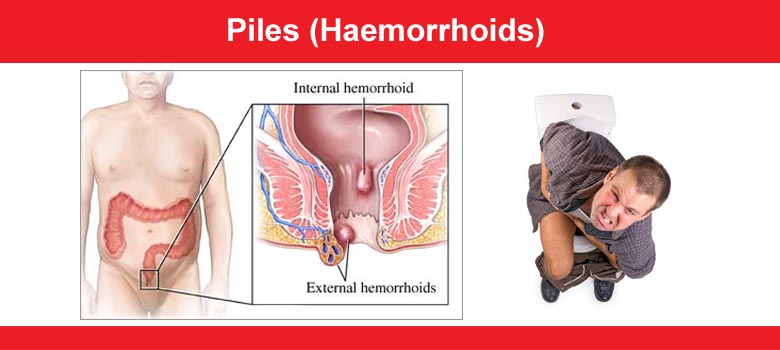 Piles (haemorrhoids)