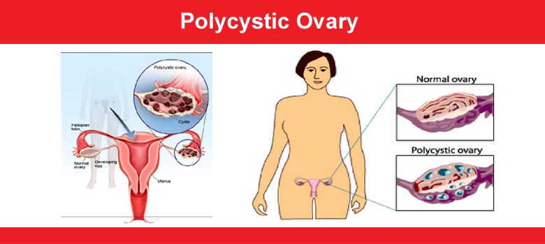 Ovarian Cyst (PCOD)