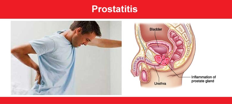 Prostatitis
