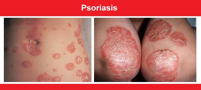 Psoriasis