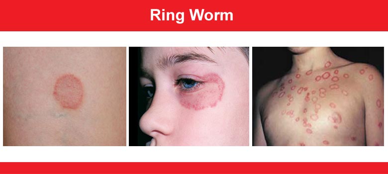 Ringworm (Fungal Rash)