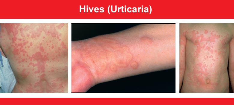 Urticaria (hives)