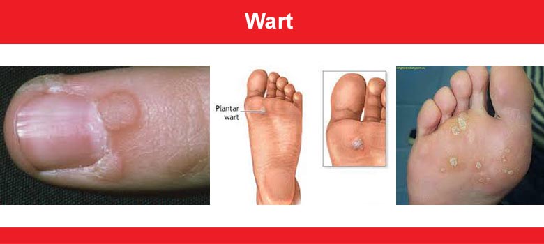 Wart