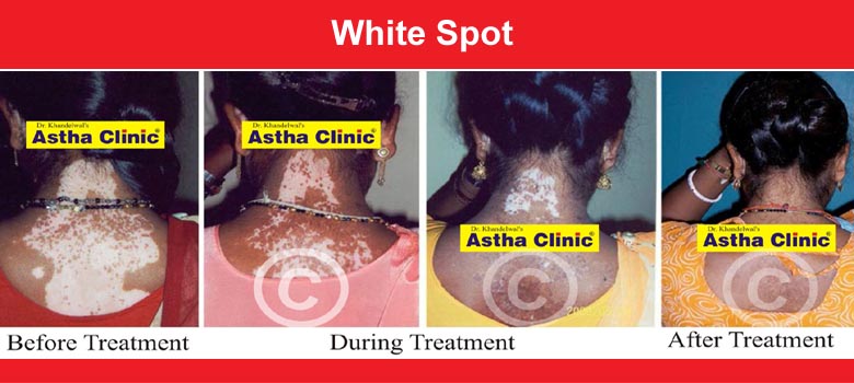 White Spot